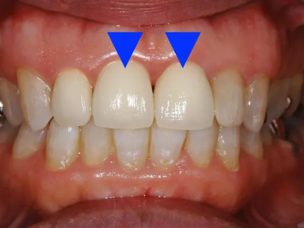 西小山歯科クリニックはオールセラミックを用いた治療を行っています