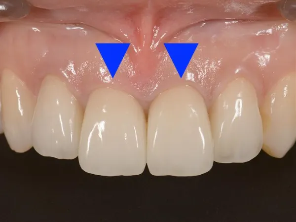 西小山歯科クリニックはジルコニアを用いた治療を行っています