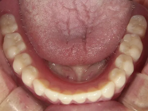 西小山歯科クリニックの入れ歯治療は保険適応の入れ歯に対応しています