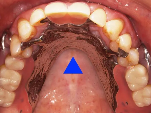 西小山歯科クリニックは金属床を用いた治療を行っています