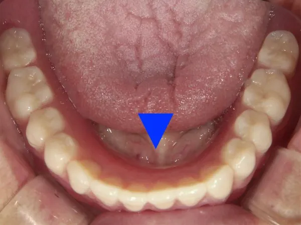 西小山歯科クリニックはレジン床（総義歯）を用いた治療を行っています