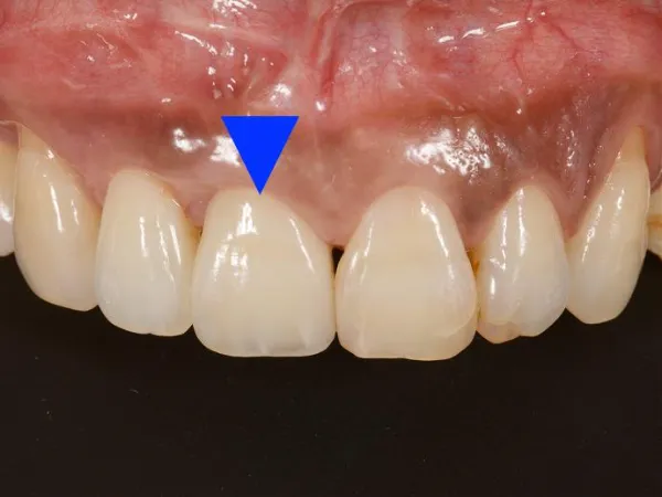 セラミッククラウン症例：前歯1本の治療後