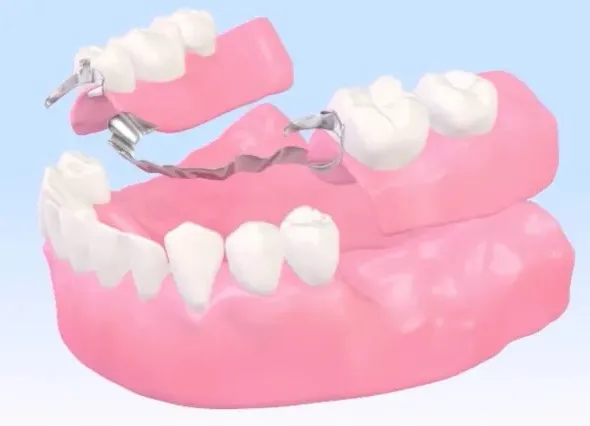 入れ歯治療のイメージ