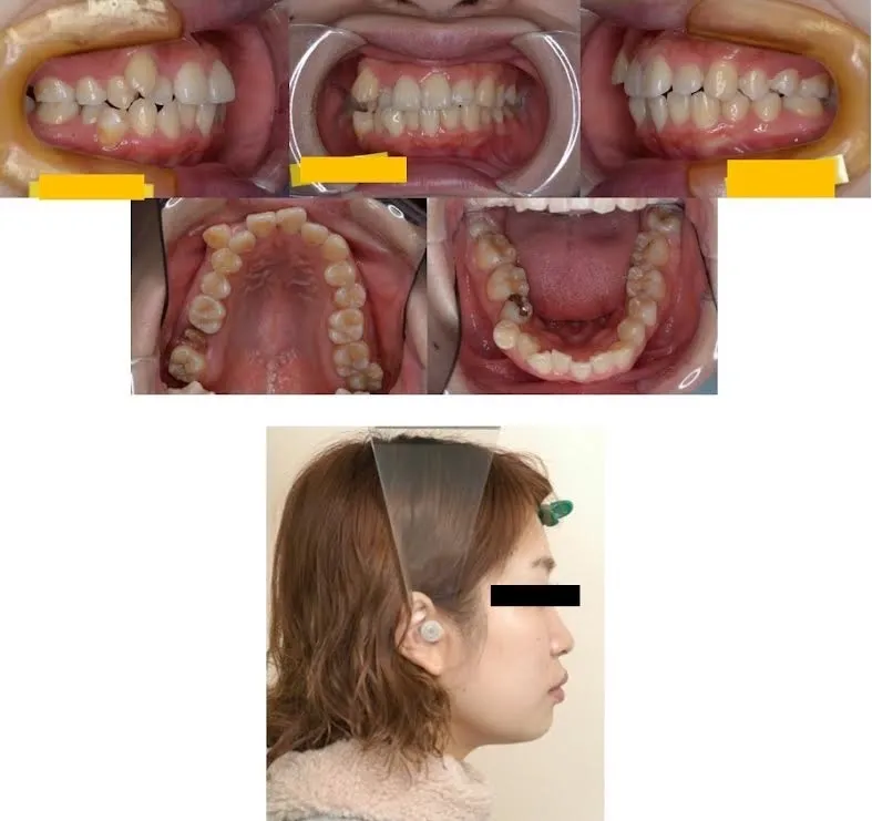 西小山歯科クリニックのワイヤー矯正施術前の状態です