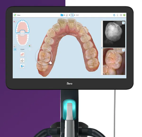 iTero口腔内スキャナーの3Dスキャン画面